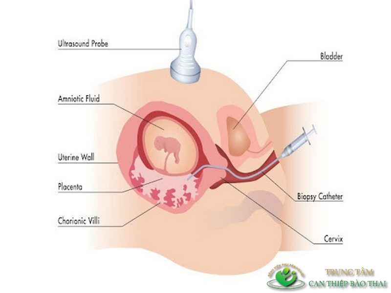 Sinh thiết gai nhau được áp dụng để lấy mẫu tế bào là phần màng đệm bao bọc quanh phôi thai