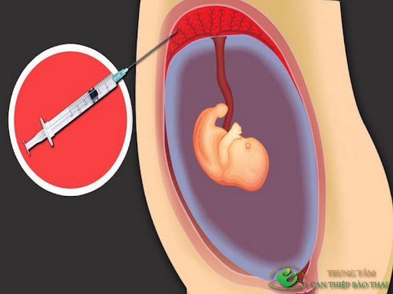 Sinh thiết gai nhau là gì?