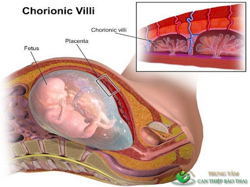 Sinh thiết gai nhau là việc làm cần thiết để tìm ra các rối loạn di truyền ở thai nhi